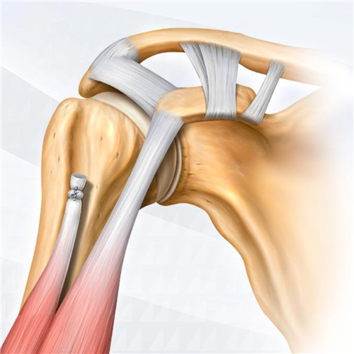 Sản phẩm Nội soi Parcus - Medacta